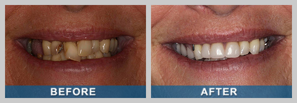 Dentures Before and After Treatment