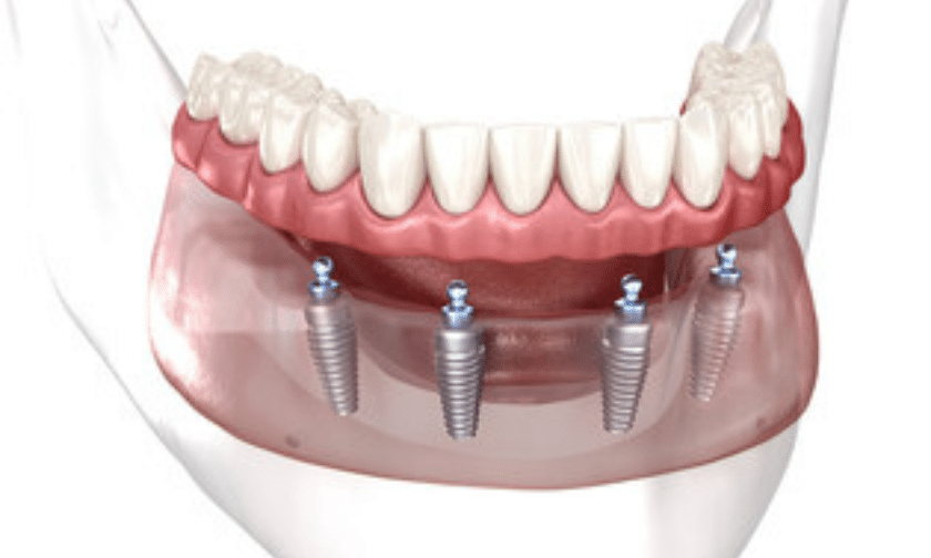 Benefits of all-on-4 dental implants and how they work