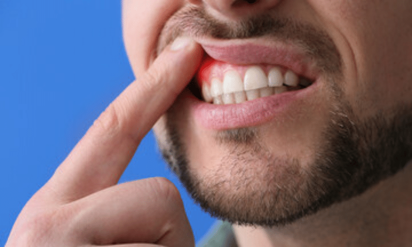 everything about gum disease