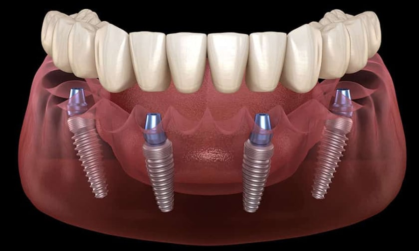 All On 4 Dental Implants Reno