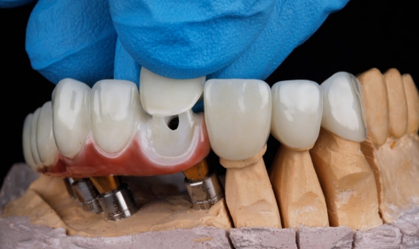 Common Cosmetic Dentistry Procedures and Their Benefits