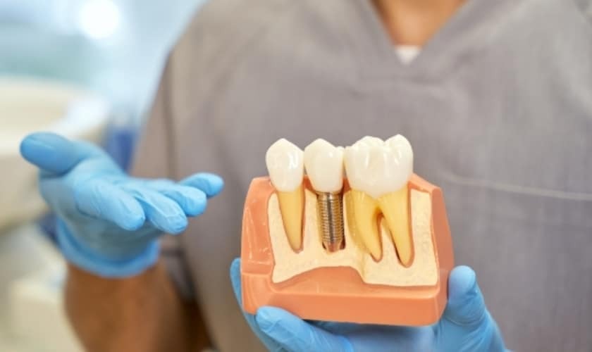 How Do Dental Implants Work? A Detailed Look at Tooth Replacement