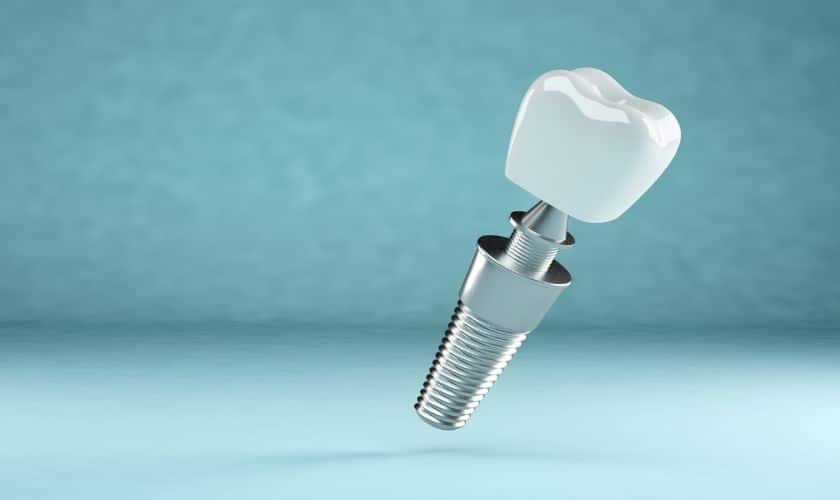Why Dental Implants Are Worth Considering