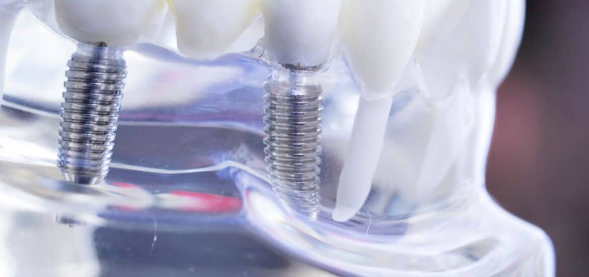 Dental Implants in Reno