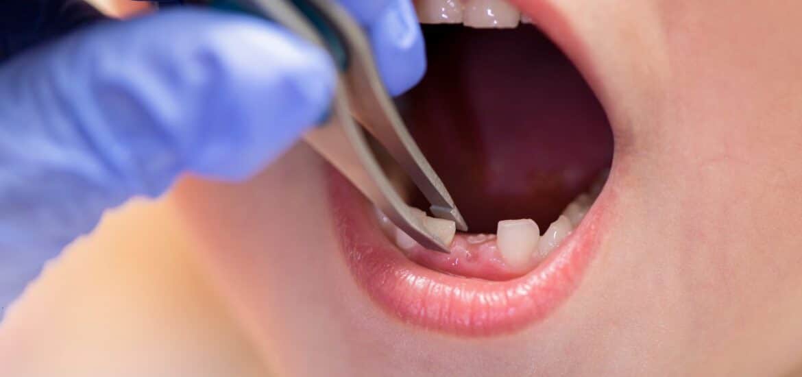 Tooth Extraction in Reno