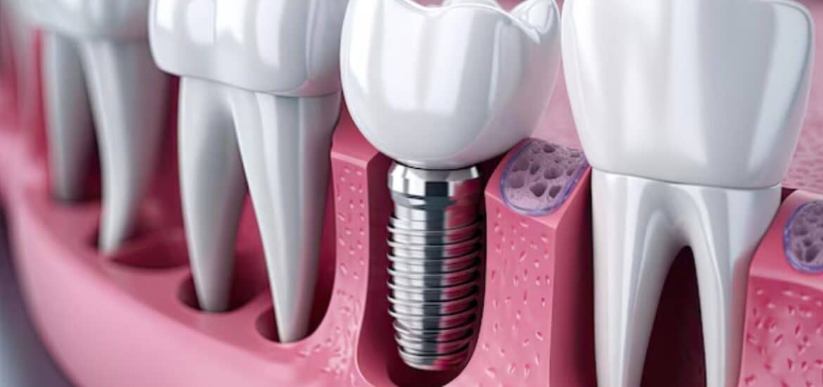 Dental Implants Reno