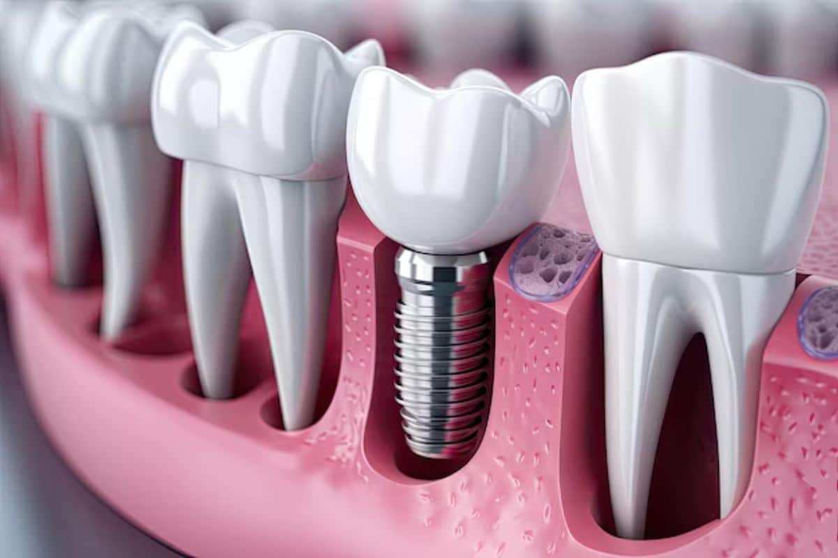 Dental Implants vs. Bridges: What’s the Better Option in Reno?