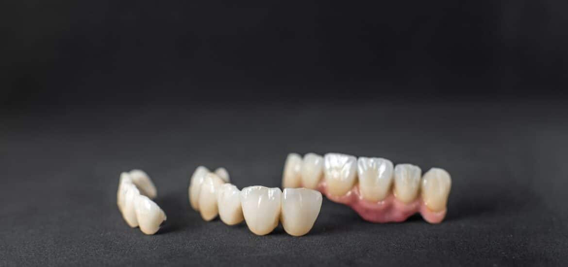Custom dental crowns and bridge designed for same day restoration technology.